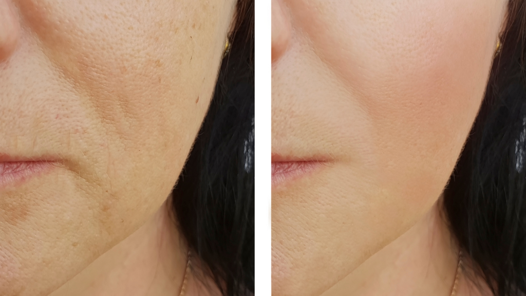 How Can Collagen Improve Your Skin